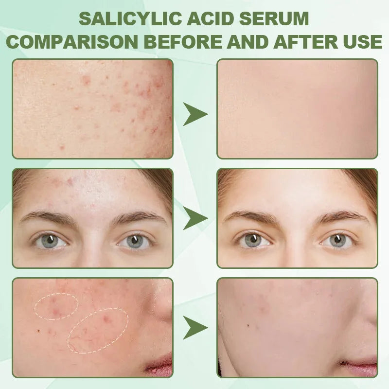 Salicylic Acid Acne Removing Essence Face Serum